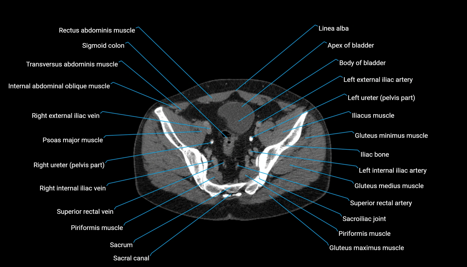 CT urogram axial cross sectional anatomy  labelled radiology image-00200.webp